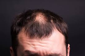 ما هي أنواع تساقط الشعر؟